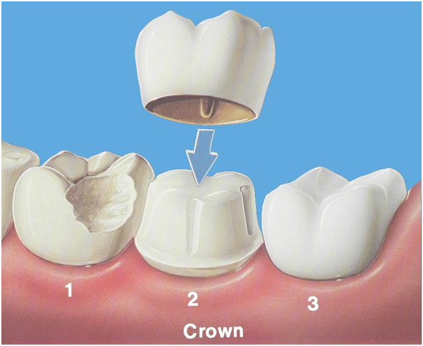 Dental crowns shown at the top and bottom, illustrating dental crowns and bridges in Indore.